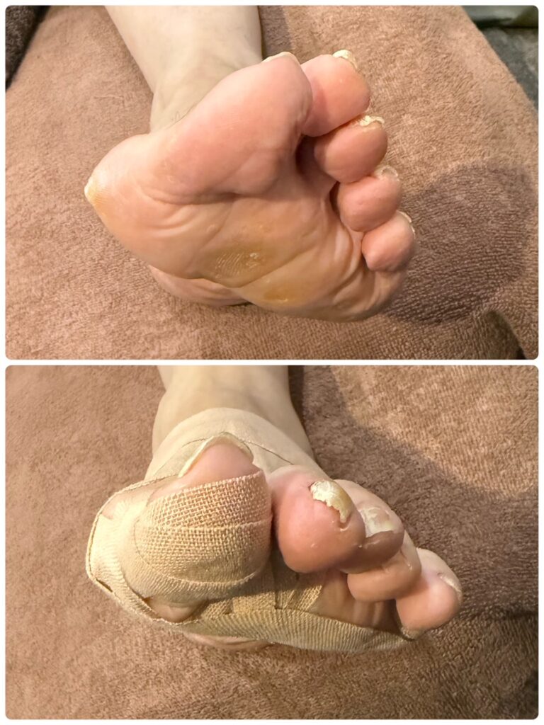 距骨調整 50代男性 左足