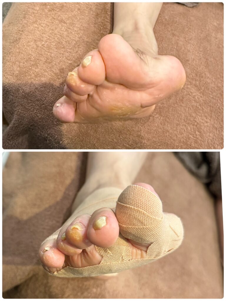 距骨調整 50代男性 右足