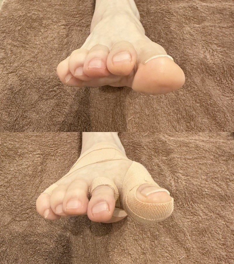 距骨調整 70代女性 右足