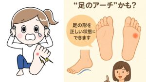 【繰り返す魚の目】その痛み「足のアーチ」が原因かも？根本足もとケア
