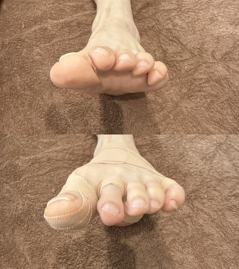 距骨調整 70代女性 左足