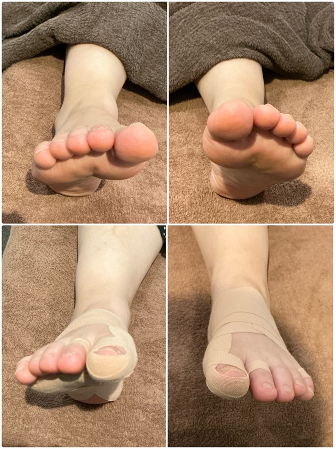 距骨調整 40代 女性