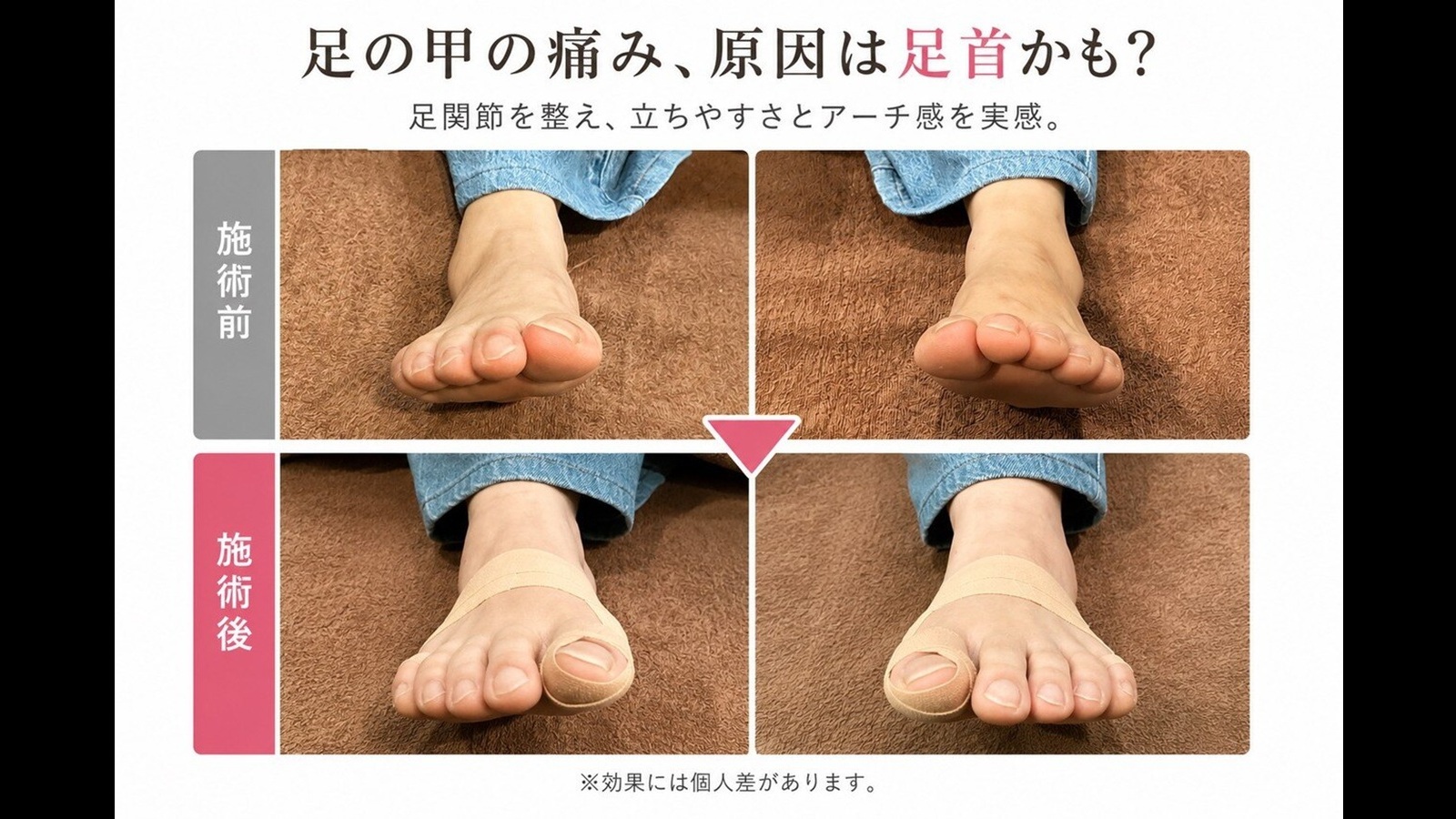 足の甲が痛い…原因は痛む場所ではなく「足首のねじれ」?【50代女性の事例】