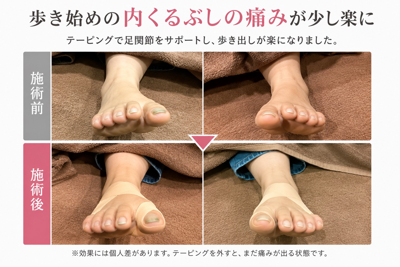 歩き始めの内くるぶしの痛みが少し楽になりました